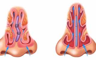 Искривление носа — лечение и операция