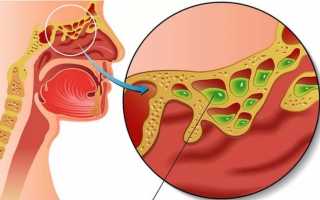 Микозы носа и околоносовых пазух — симптомы и лечение