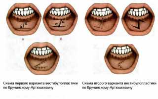 Причины и особенности проведения вестибулопластики нижней челюсти