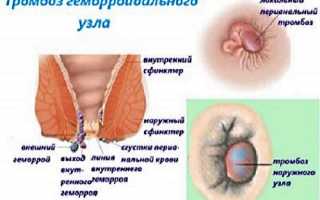 Почему возникает геморрой у женщин и как его лечить?