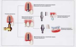 Чем отличается одномоментная имплантация зубов от обычной процедуры?