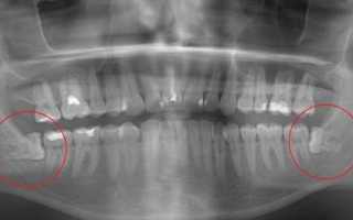 Растет зуб мудрости и болит десна: как облегчить симптомы и что делать?