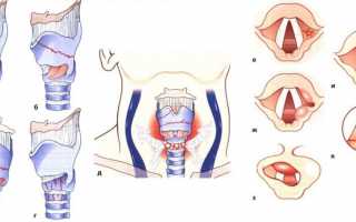 Травмы гортани — симптомы и лечение