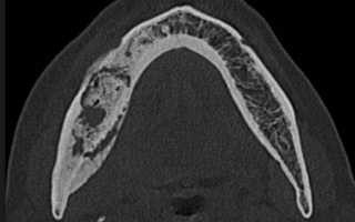 Насколько опасен некроз челюсти, как его определить и как вылечить?