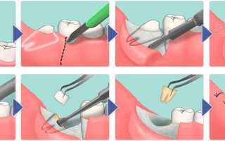 Какие выды швов применяются после удаления зубов мудрости и основное их предназначение?