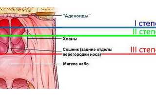 Симптомы и лечение аденоидов 3 степени