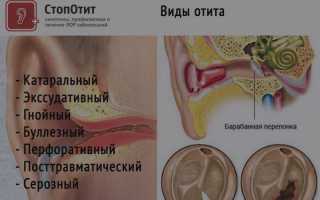 Народные способы, как вылечить ухо в домашних условиях