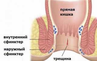 В чем отличие анальных трещин от геморроя, в чем их связь и как это всё лечить?