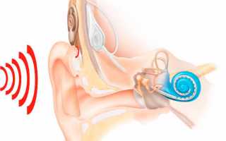 Лечение кохлеарного неврита