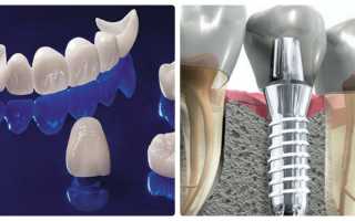Лучше выбрать протезирование коронками или имплантацию?