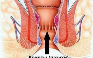 Заболевание криптит: что это, каковые его симптомы и причины появления?