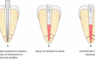 Методы обтурации корневых каналов и какие материалы используют при процедуре