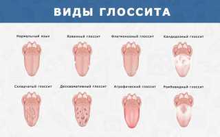 Глоссит языка: причины, симптомы и лечение