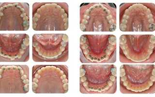 Стесняетесь обычных брекетов? Тогда вам идеально подойдут лингвальные конструкции