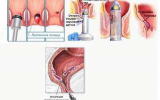 Что делать, если не получается вылечить геморрой?