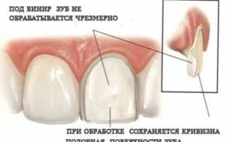 Что такое препарирование зубов и для чего проводят подобную процедуру?