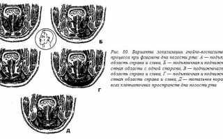 Локализация флегмоны дна полости рта и какими методами проводят ее лечение?