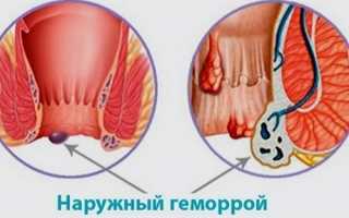 Что такое комбинированный или смешанный геморрой?