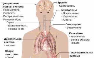 Инфекционный мононуклеоз — симптомы и лечение