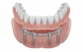 Когда применяют балочный протезы на имплантах в стоматологии?
