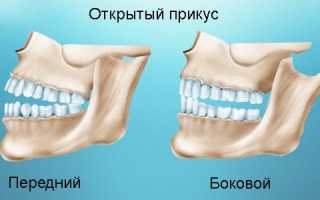 Насколько важно вовремя лечить открытый прикус и что делать при запущенном случае?