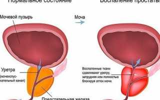 При геморрое болит низ живота, что делать?