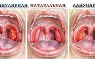 Насколько эффективен Хлорофиллипт при ангине?