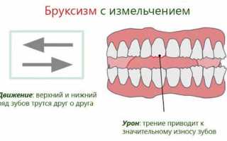 Почему у взрослых возникает бруксизм и стоит ли его немедленно лечить?