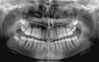 Как делают панорамный снимок зубов?