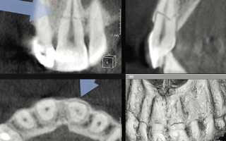 Когда сломан корень зуба, что стоит делать пациенту?