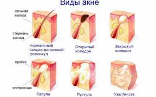 Мазь от прыщей: обзор популярных и рейтинг самых эффективных средств по уходу за кожей (115 фото и видео)