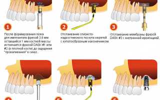 Что такое синус-лифтинг и для чего он применяется в стоматологии?