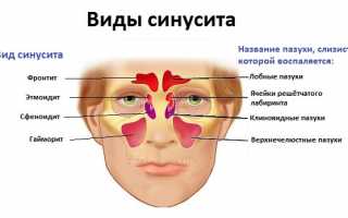 Гайморит и способы его лечения