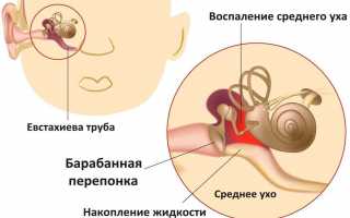 Лечение двухстороннего отита у взрослых и детей