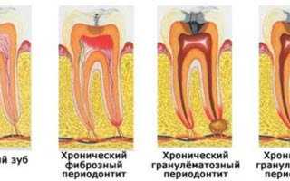 Что такое гранулирующий периодонтит, каковы его формы и чем он опасен?