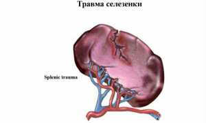 Ушиб селезенки что делать