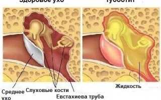 Как лечить острый тубоотит