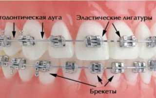 Кому подойдут керамические брекеты, а кому лучше выбрать другой вид конструкций?