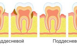 Каким образом удаляют поддесневой зубной камень в стоматологии?