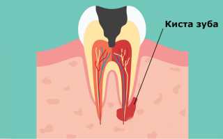 Лечение кисты зуба хирургически, с помощью лазера или в домашних условиях