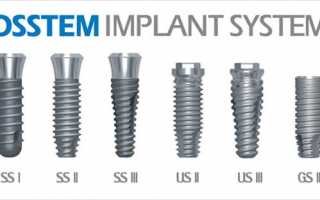 Основные преимущества имплантов Osstem и подробные их характеристики