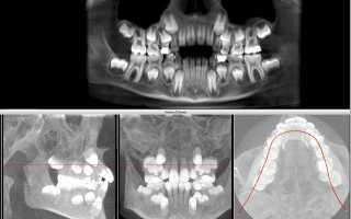 Для каких целей проводят процедуру компьютерной 3D томографии зубов?