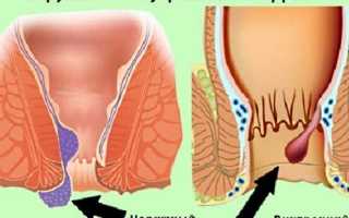 Из-за чего у девушек появляется геморрой?