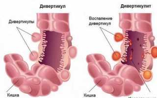 Симптомы и лечение дивертикулита кишечника