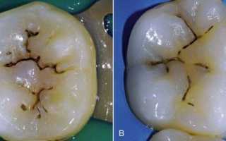 Что такое фиссурный кариес и какие есть методы его лечения?
