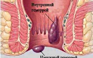 Как может выглядеть геморрой: фото по видам и стадиям у детей и взрослых