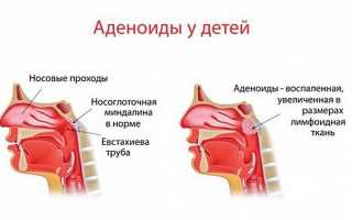 Применение масла туи при аденоидах