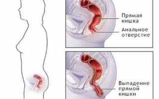 Какие могут быть осложнения после удаления геморроя?