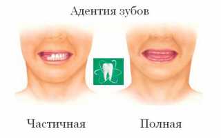 Адентия зубов – приговор или неприятность? Методы лечения заболевания