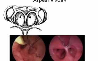 Атрезия хоан — симптомы и лечение